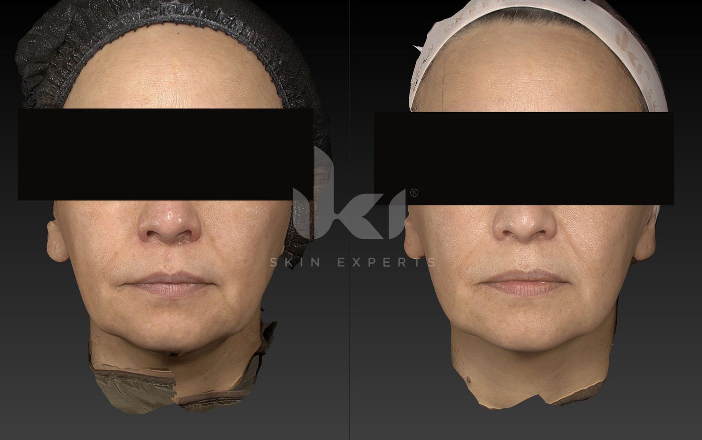 Antes y después de otros casos en IKI Skin Experts, caso 30, identidad protegida