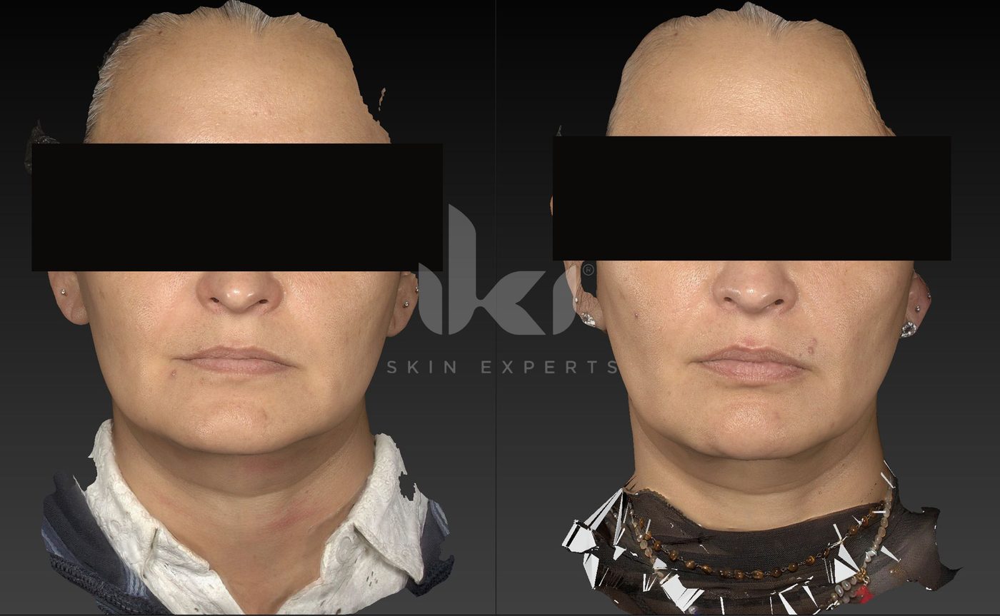 Antes y después de otros casos en IKI Skin Experts, caso 31, identidad protegida