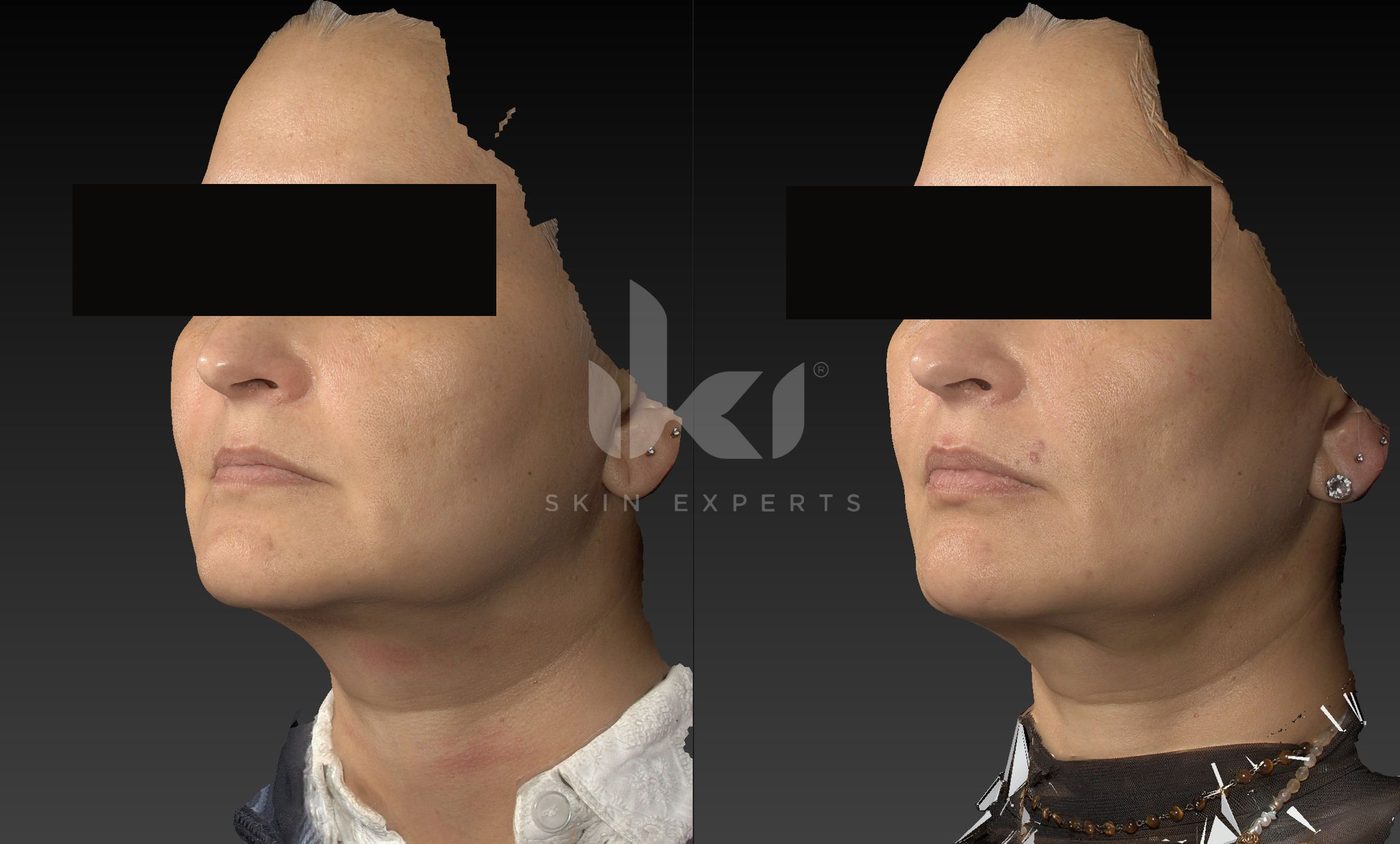 Antes y después de otros casos en IKI Skin Experts, caso 32, identidad protegida