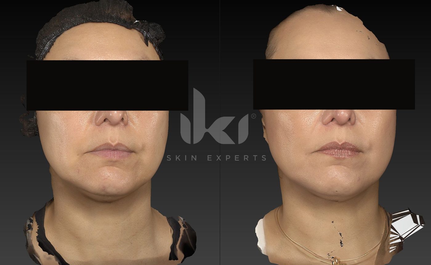 Antes y después de hifu · flacidez en IKI Skin Experts, caso 19, identidad protegida