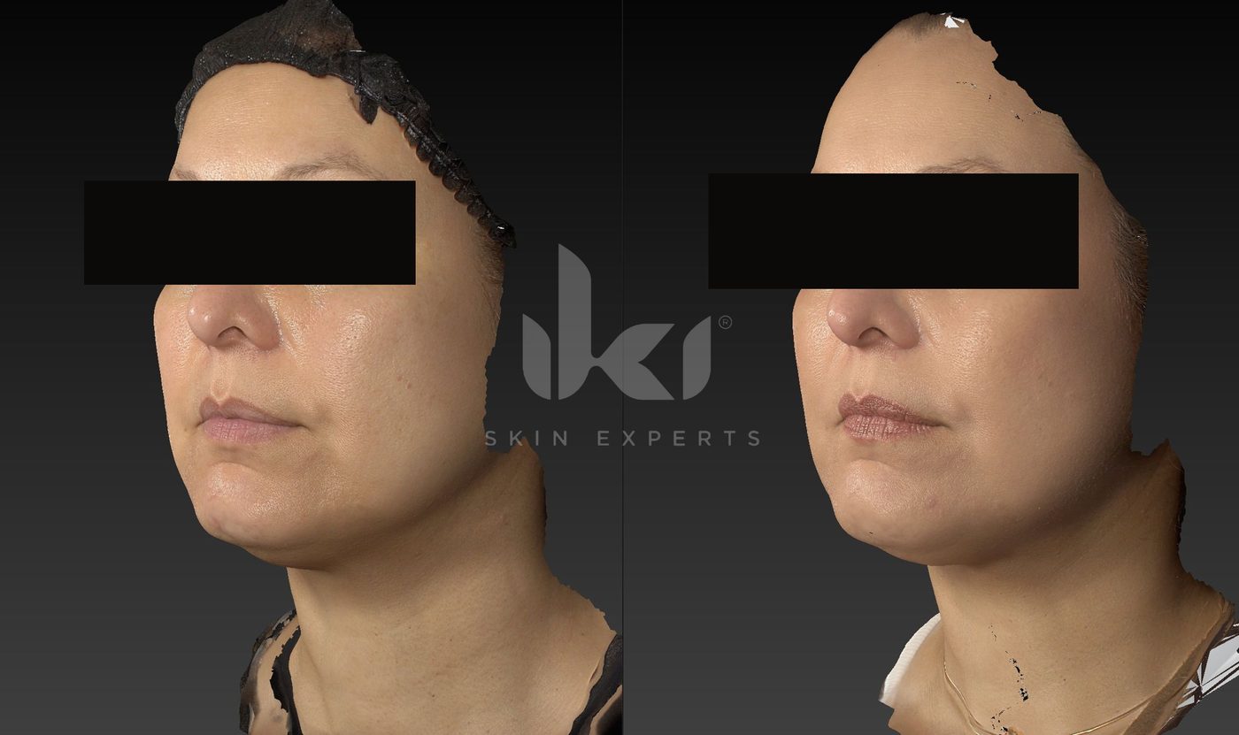 Antes y después de hifu · flacidez en IKI Skin Experts, caso 20, identidad protegida
