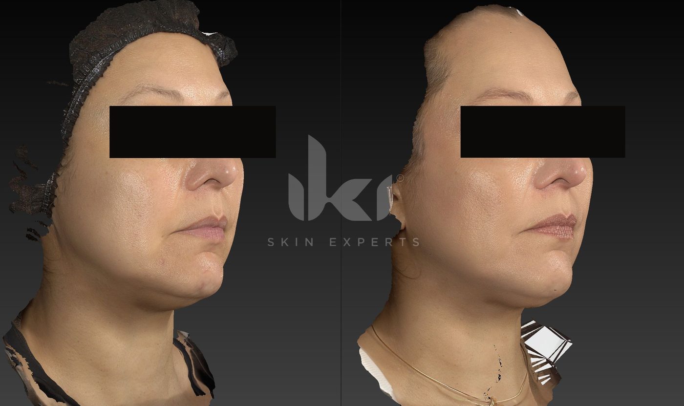 Antes y después de hifu · flacidez en IKI Skin Experts, caso 21, identidad protegida