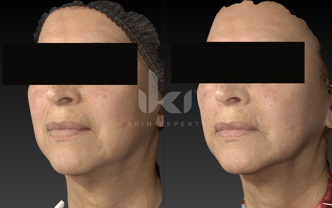Antes y después de manchas y melasma en IKI Skin Experts, caso 65, identidad protegida