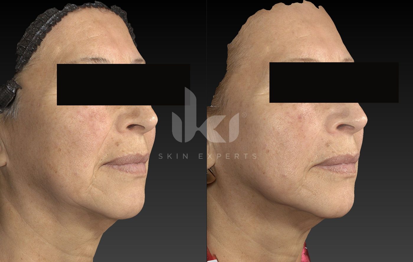 Antes y después de manchas y melasma en IKI Skin Experts, caso 66, identidad protegida