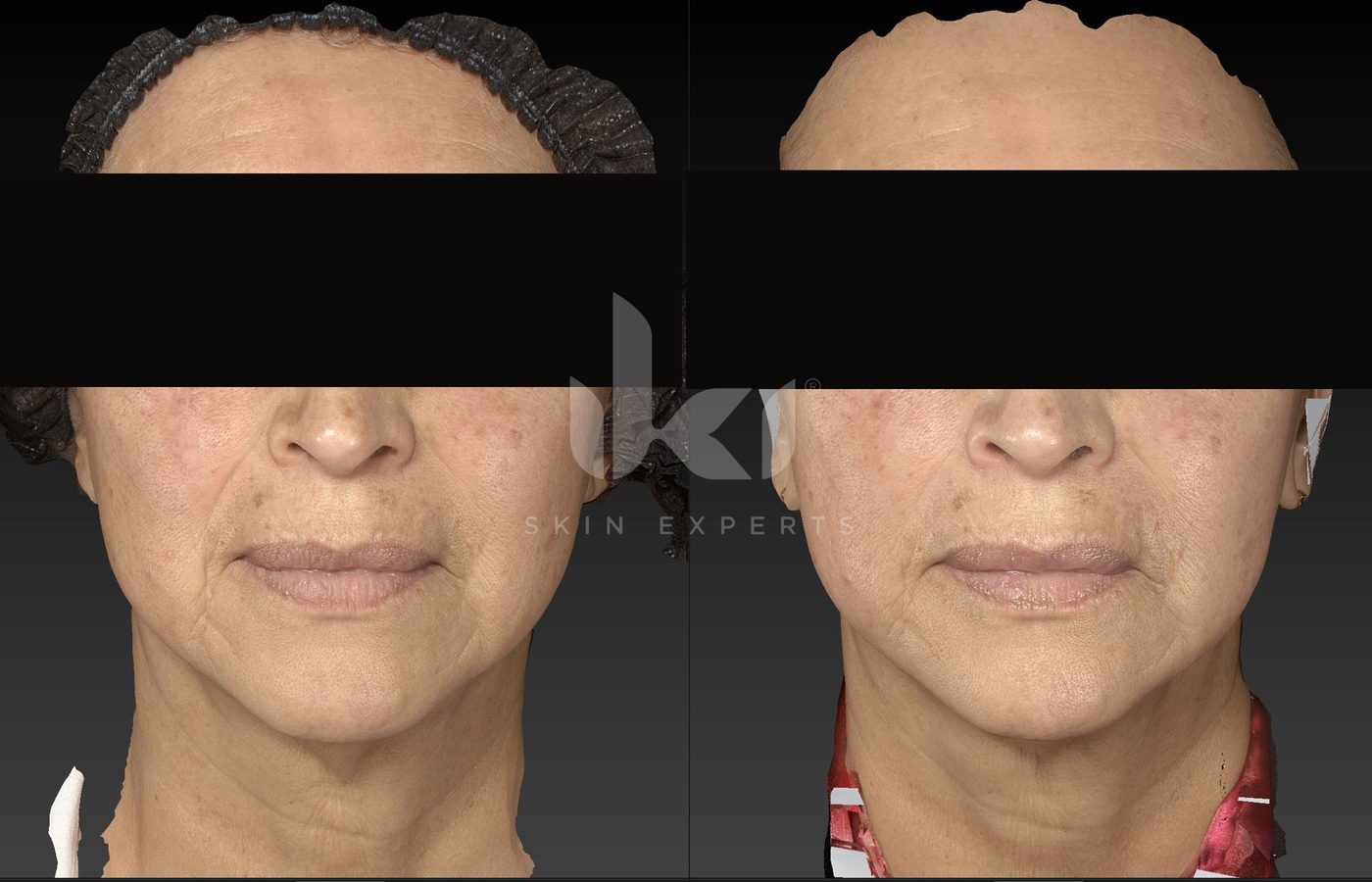 Antes y después de manchas y melasma en IKI Skin Experts, caso 67, identidad protegida