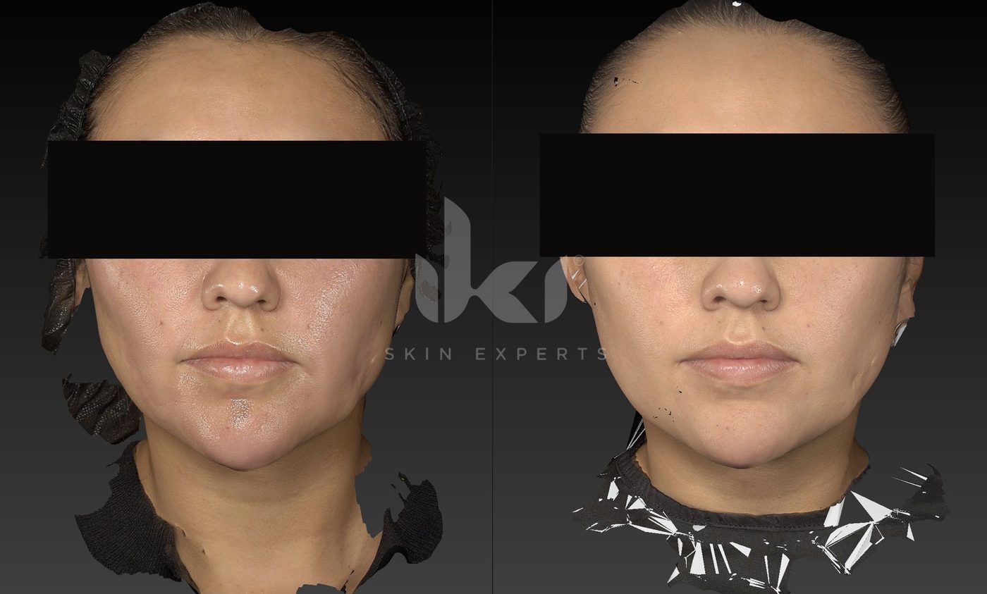 Antes y después de cicatrices en IKI Skin Experts, caso 2, identidad protegida
