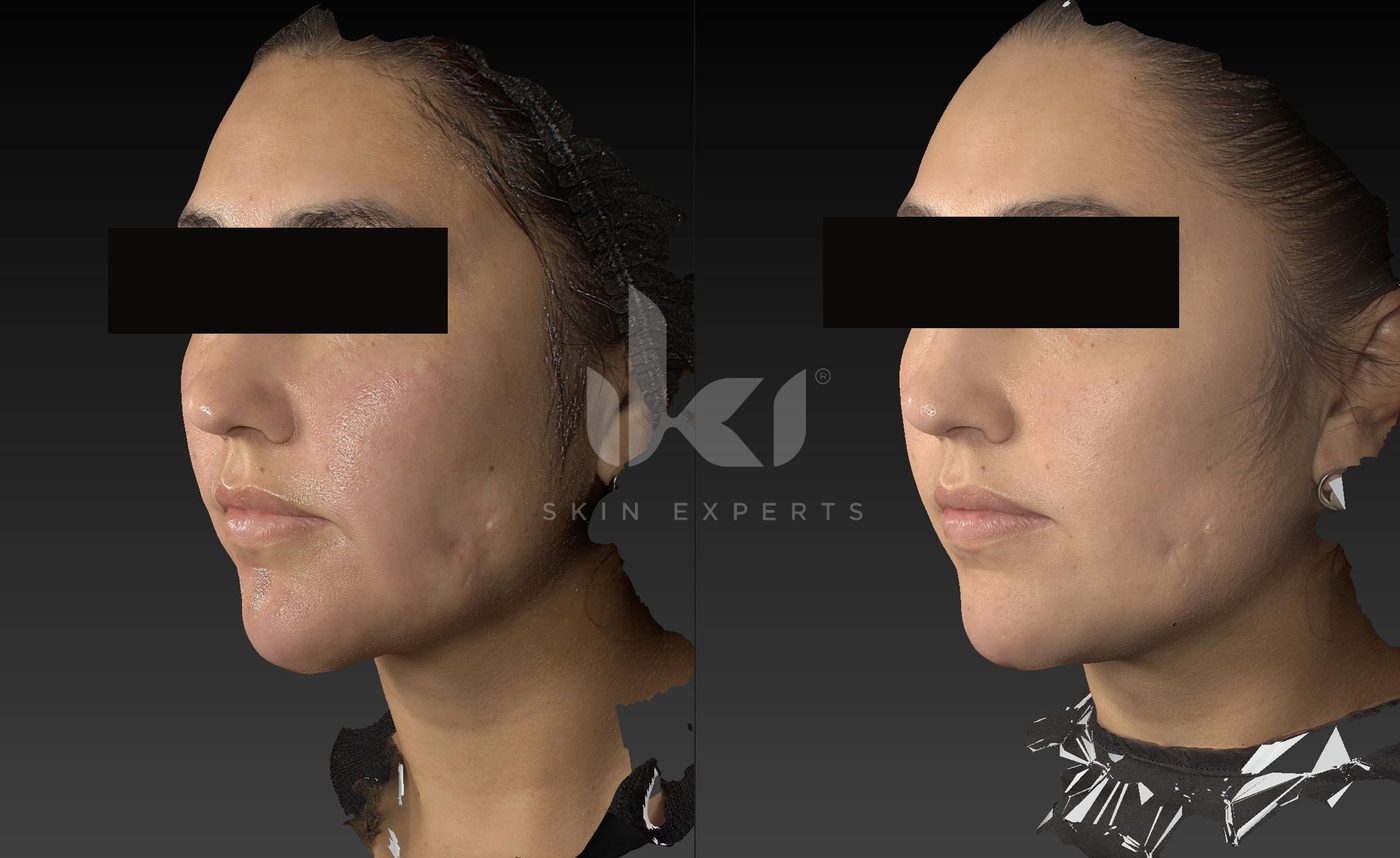 Antes y después de cicatrices en IKI Skin Experts, caso 3, identidad protegida