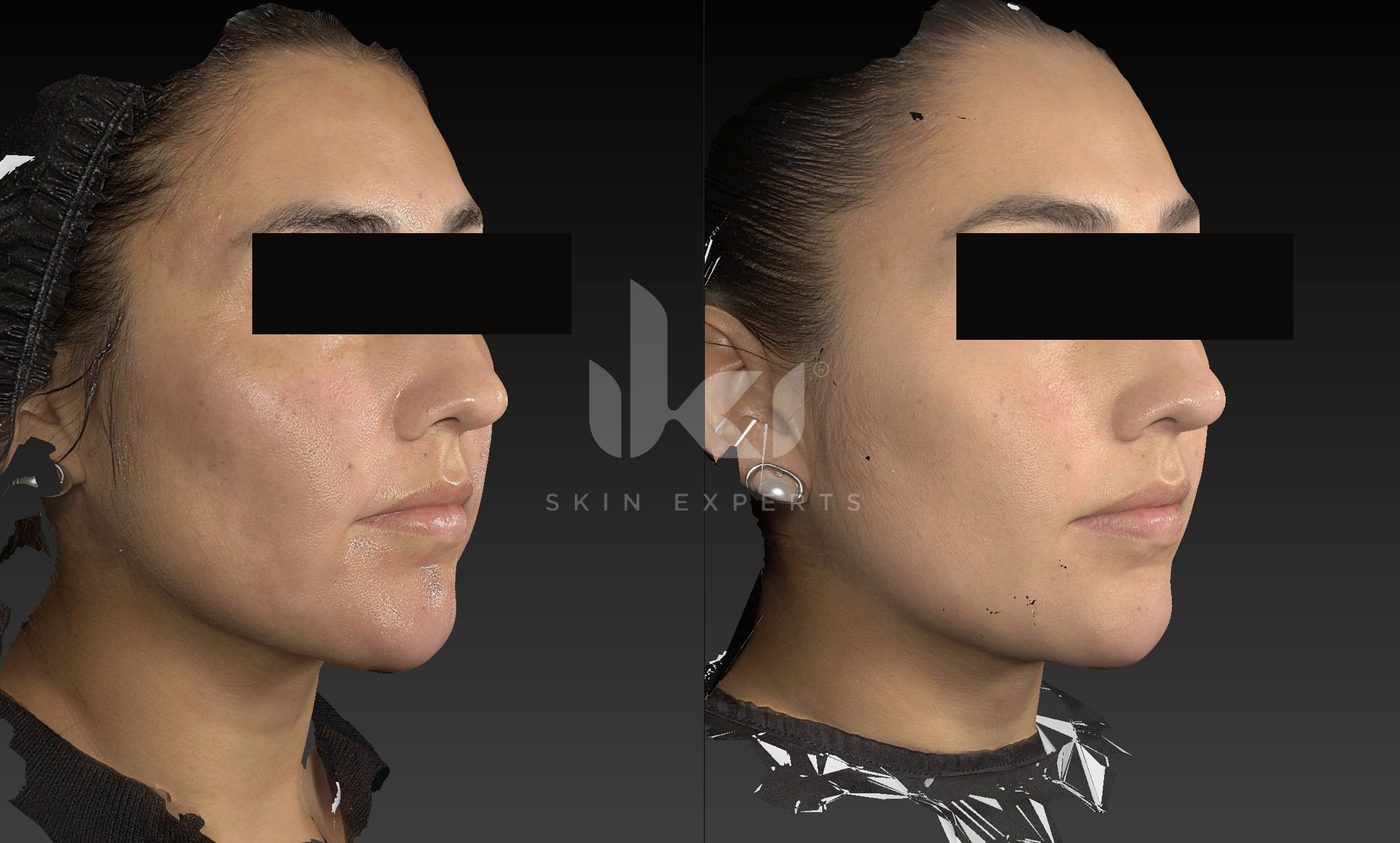 Antes y después de cicatrices en IKI Skin Experts, caso 4, identidad protegida