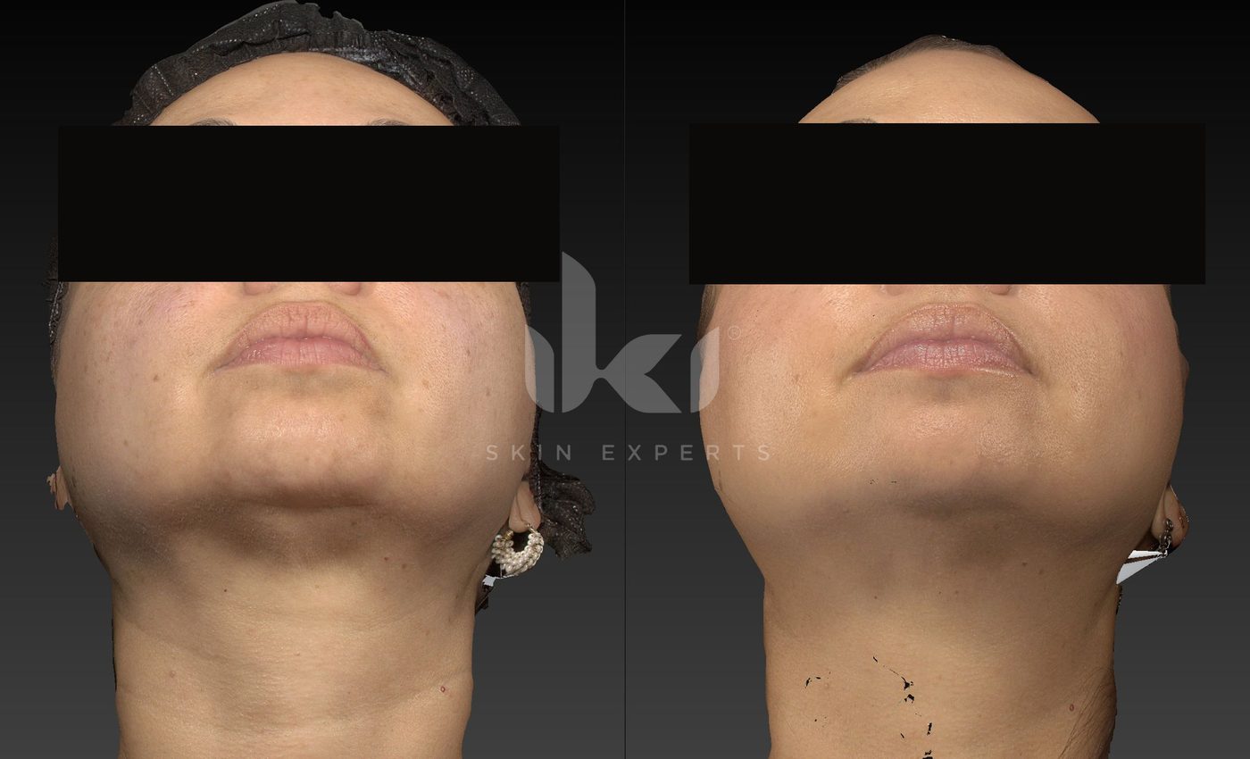 Antes y después de hifu · flacidez en IKI Skin Experts, caso 22, identidad protegida