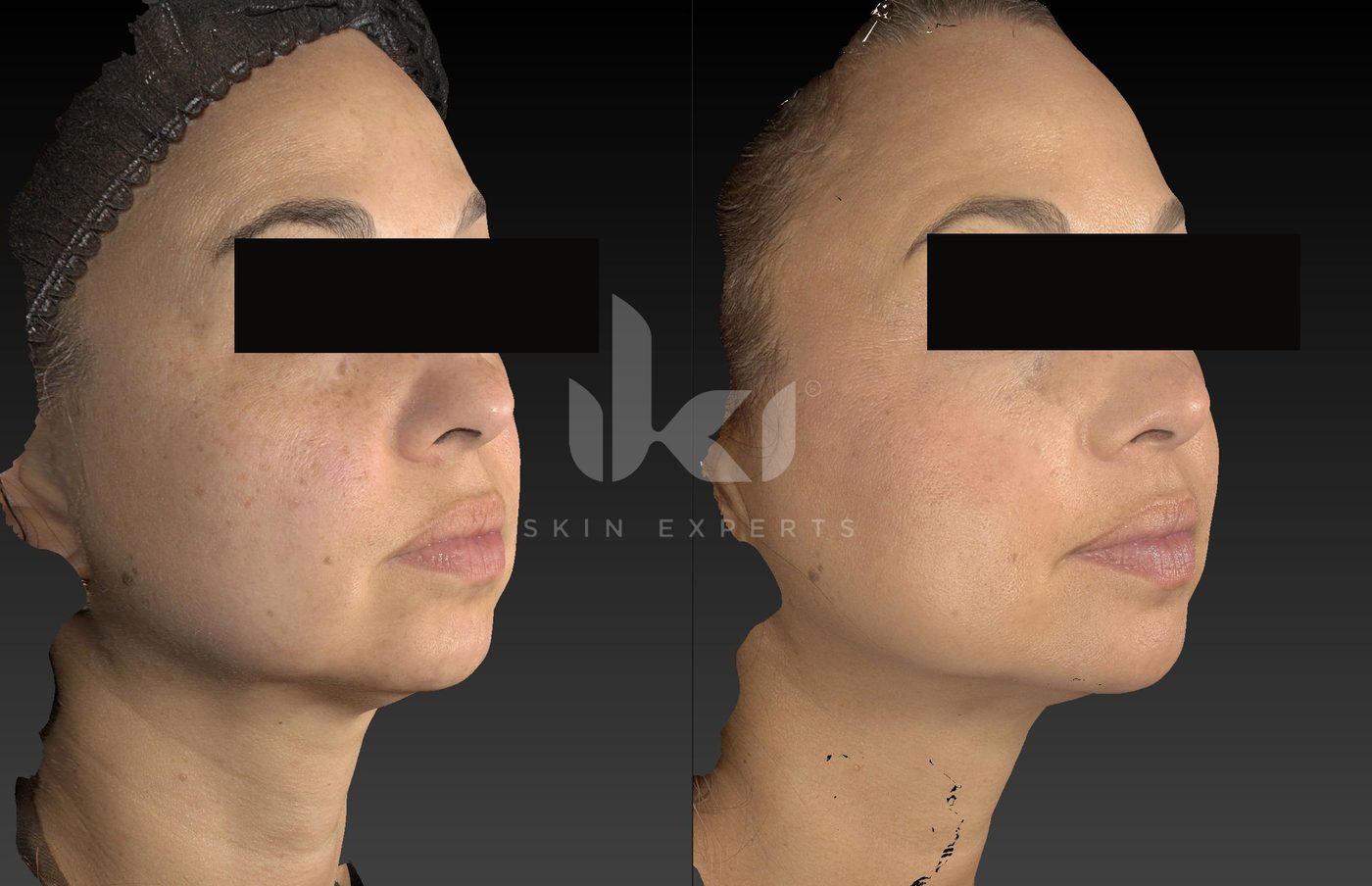Antes y después de manchas y melasma en IKI Skin Experts, caso 68, identidad protegida