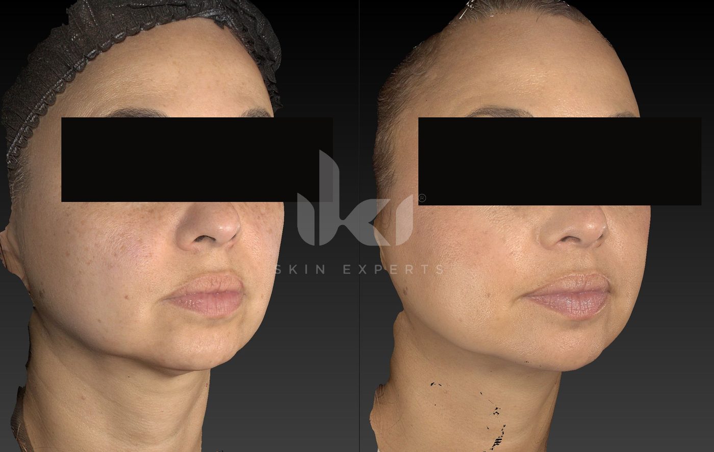 Antes y después de manchas y melasma en IKI Skin Experts, caso 69, identidad protegida