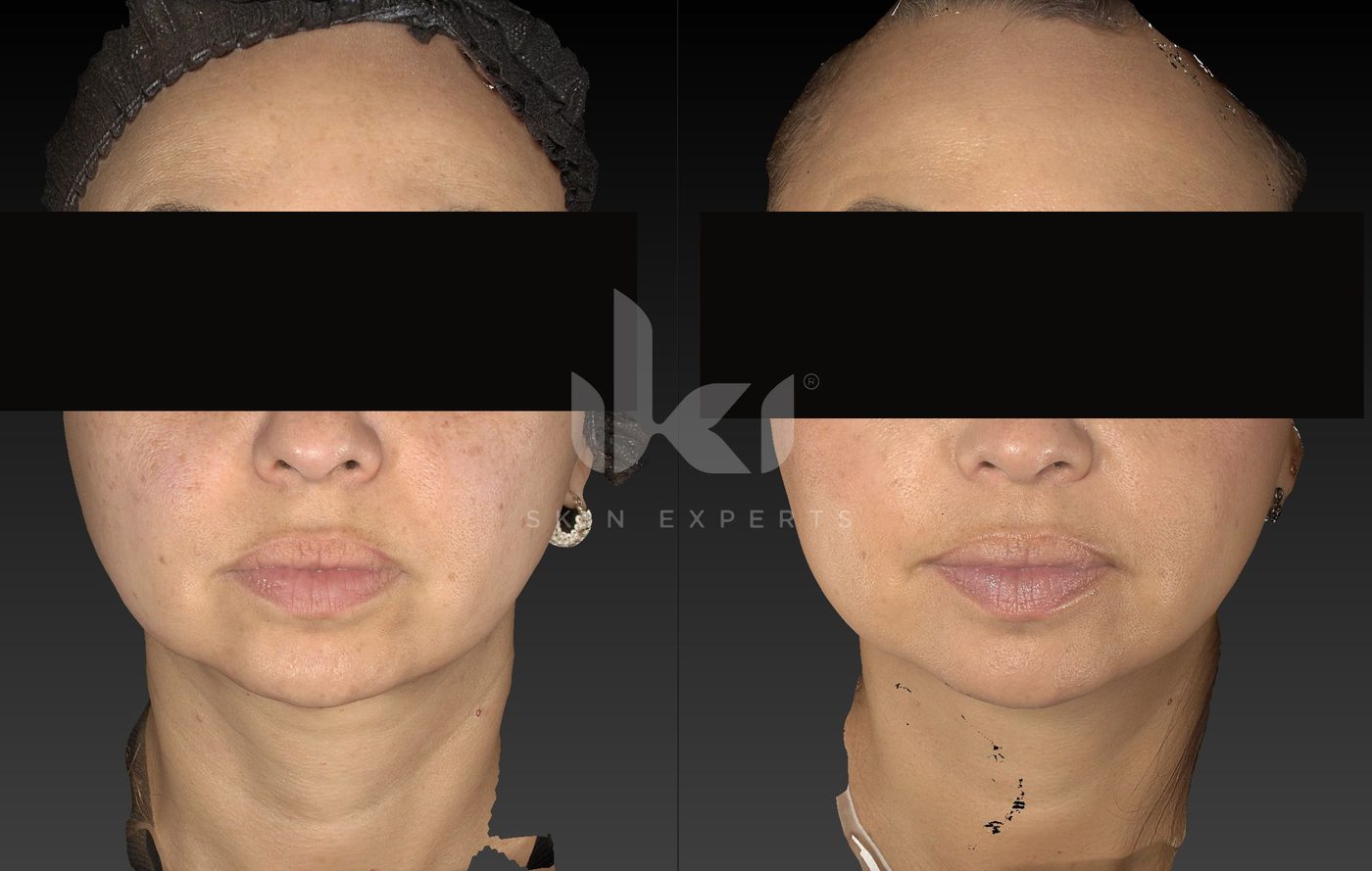 Antes y después de manchas y melasma en IKI Skin Experts, caso 70, identidad protegida