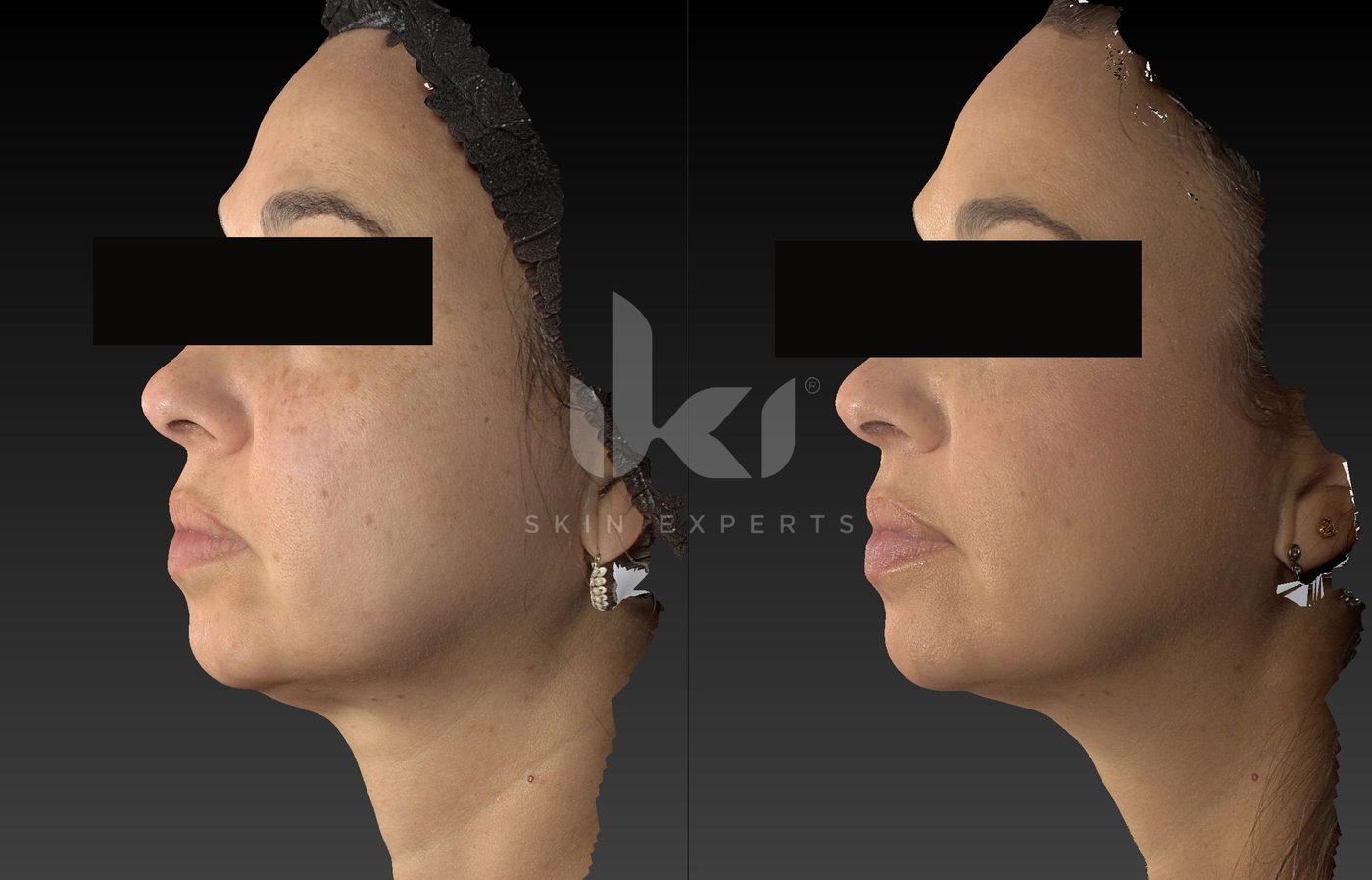 Antes y después de manchas y melasma en IKI Skin Experts, caso 71, identidad protegida
