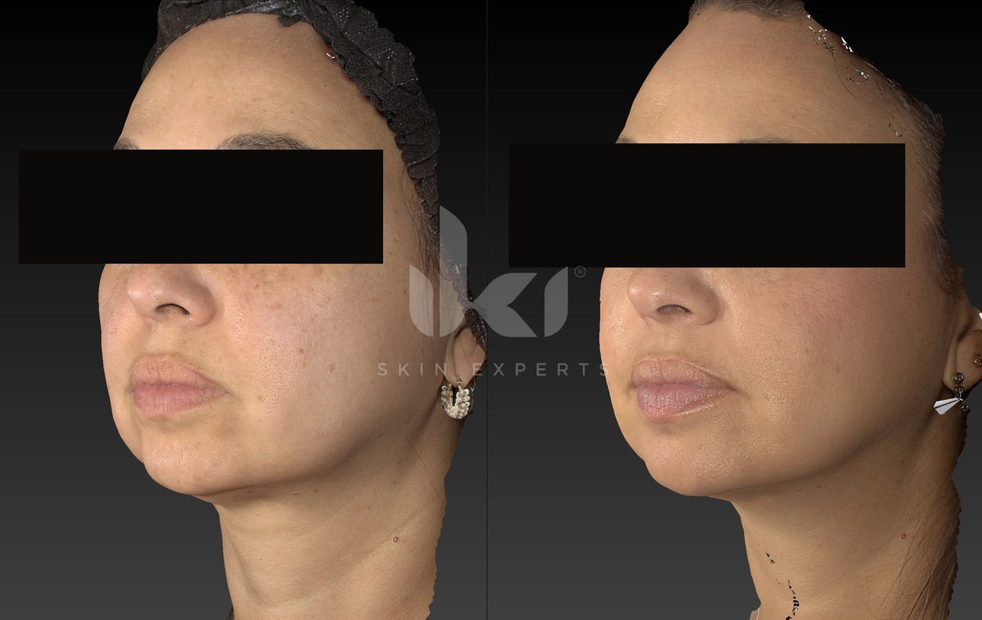 Antes y después de manchas y melasma en IKI Skin Experts, caso 72, identidad protegida