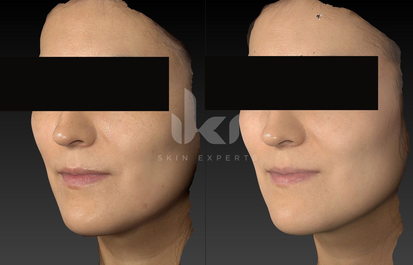 Antes y después de manchas y melasma en IKI Skin Experts, caso 73, identidad protegida