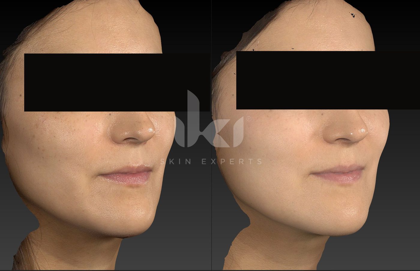 Antes y después de manchas y melasma en IKI Skin Experts, caso 74, identidad protegida