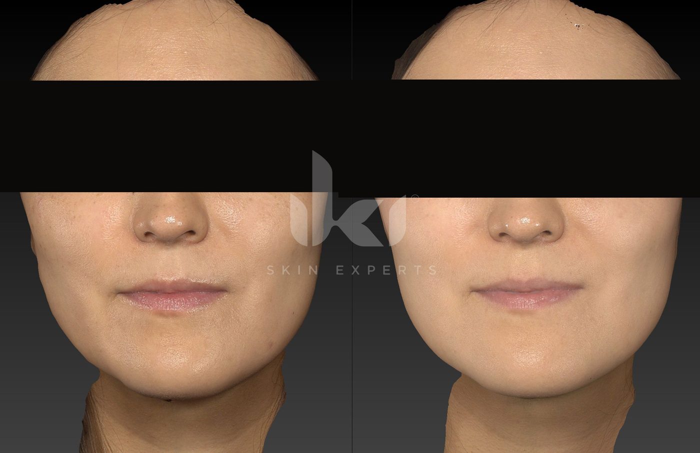 Antes y después de manchas y melasma en IKI Skin Experts, caso 75, identidad protegida