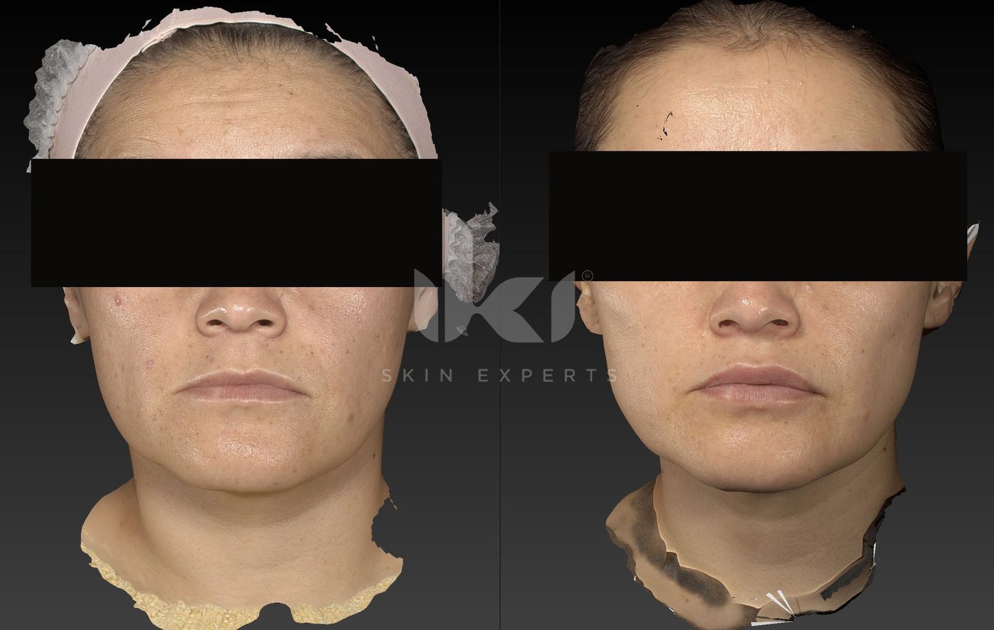 Antes y después de manchas y melasma en IKI Skin Experts, caso 76, identidad protegida