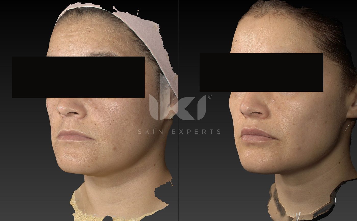 Antes y después de manchas y melasma en IKI Skin Experts, caso 77, identidad protegida