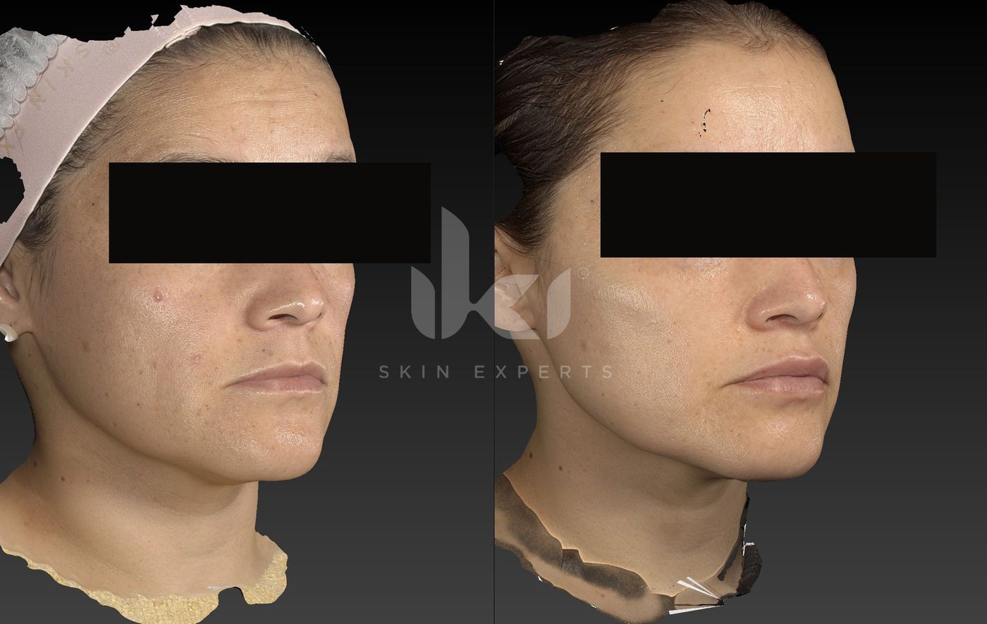 Antes y después de manchas y melasma en IKI Skin Experts, caso 78, identidad protegida