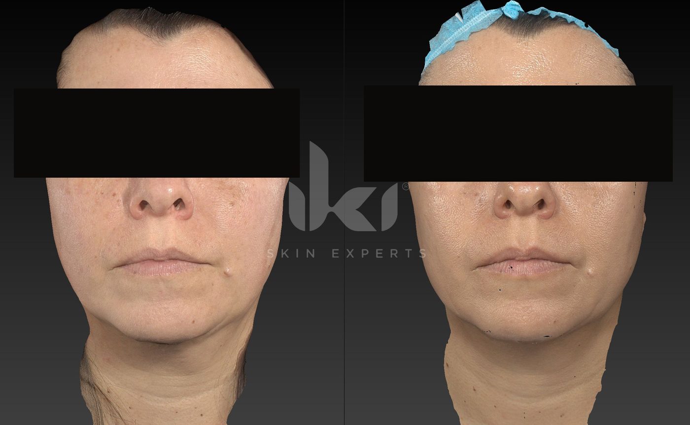 Antes y después de manchas y melasma en IKI Skin Experts, caso 79, identidad protegida