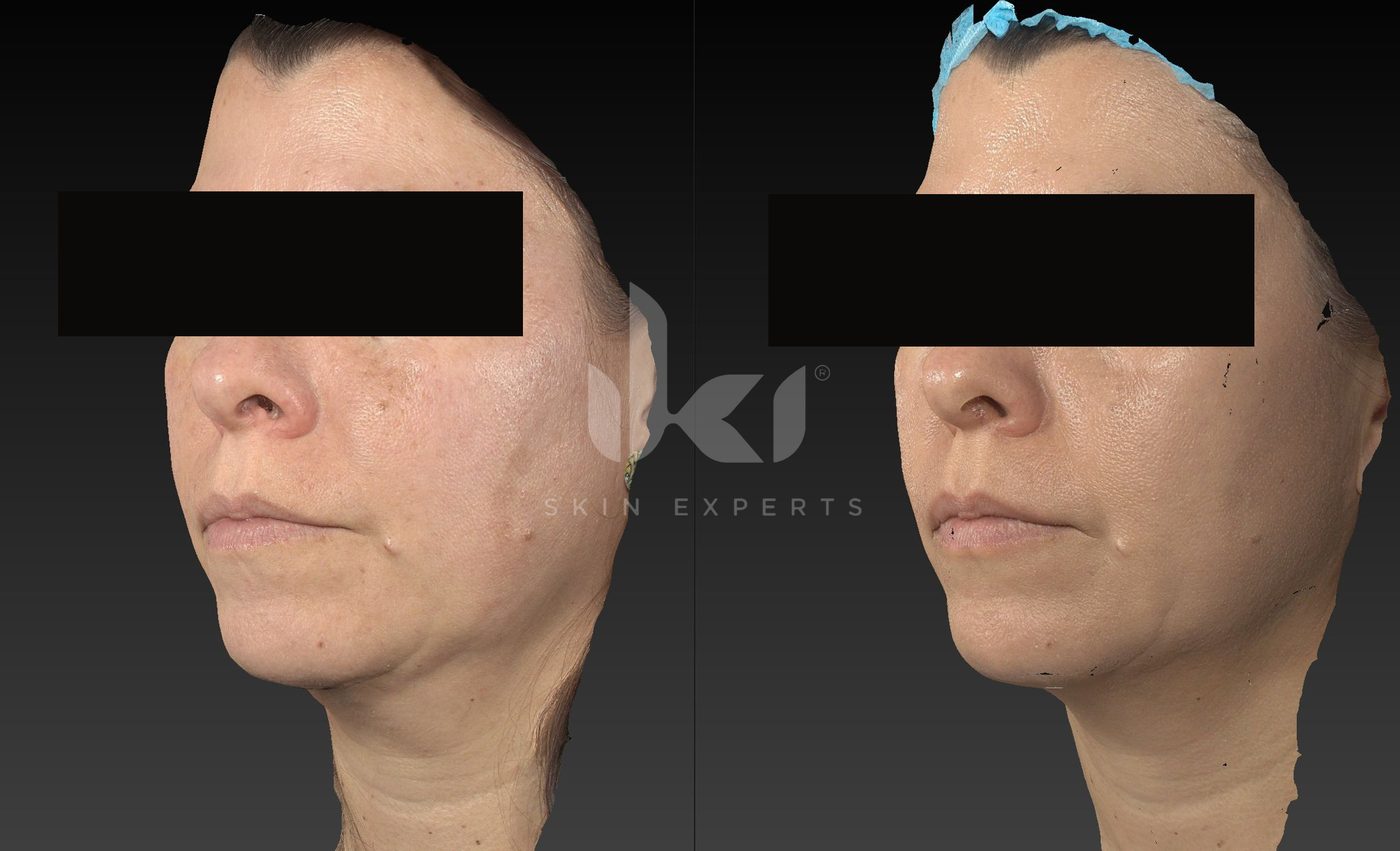 Antes y después de manchas y melasma en IKI Skin Experts, caso 80, identidad protegida