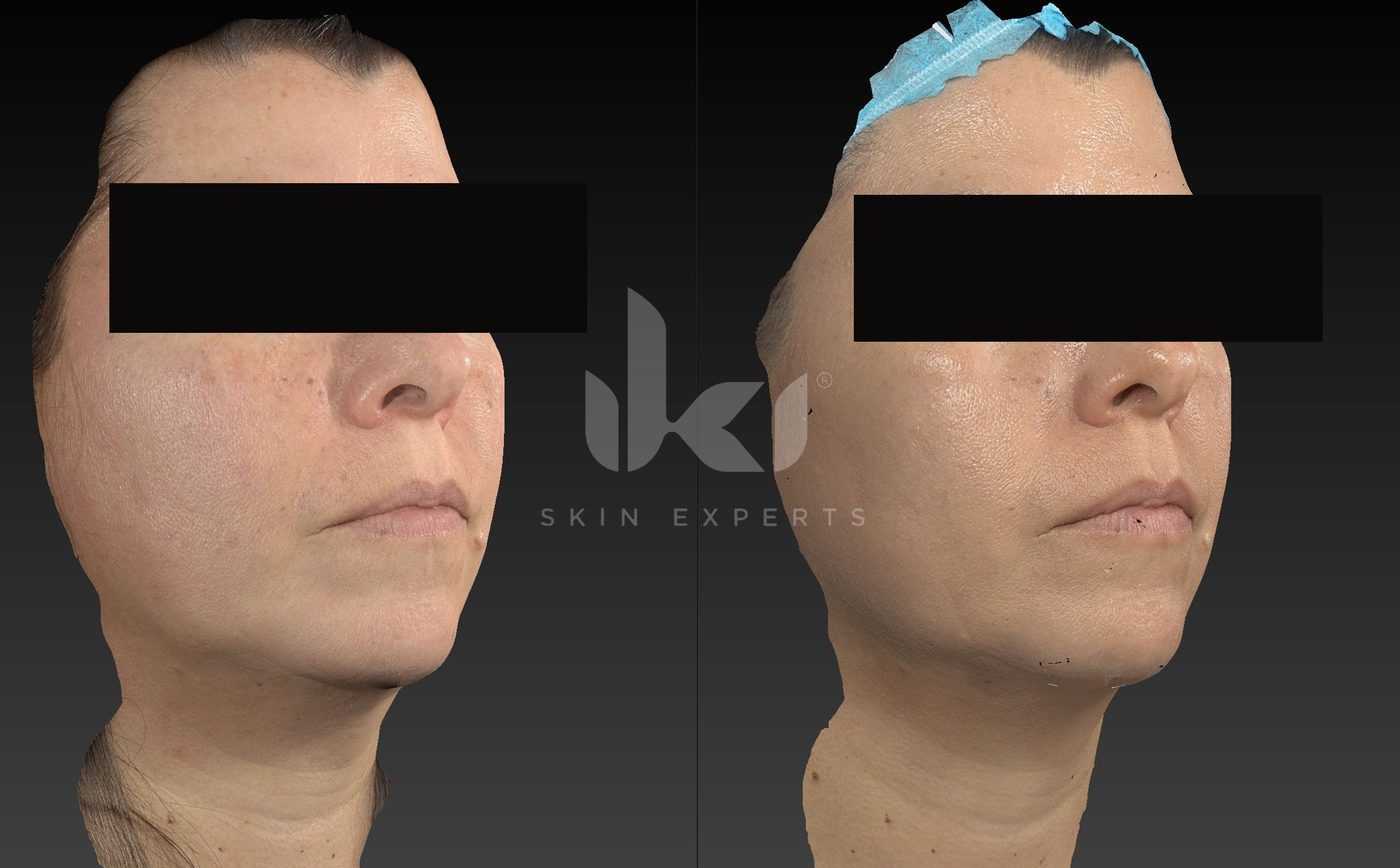 Antes y después de manchas y melasma en IKI Skin Experts, caso 81, identidad protegida