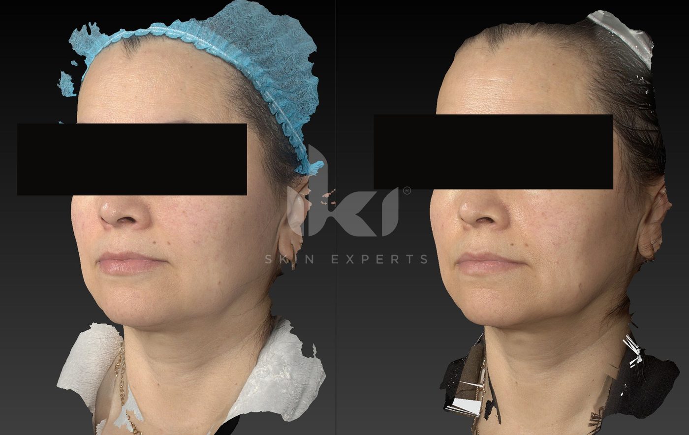 Antes y después de otros casos en IKI Skin Experts, caso 33, identidad protegida