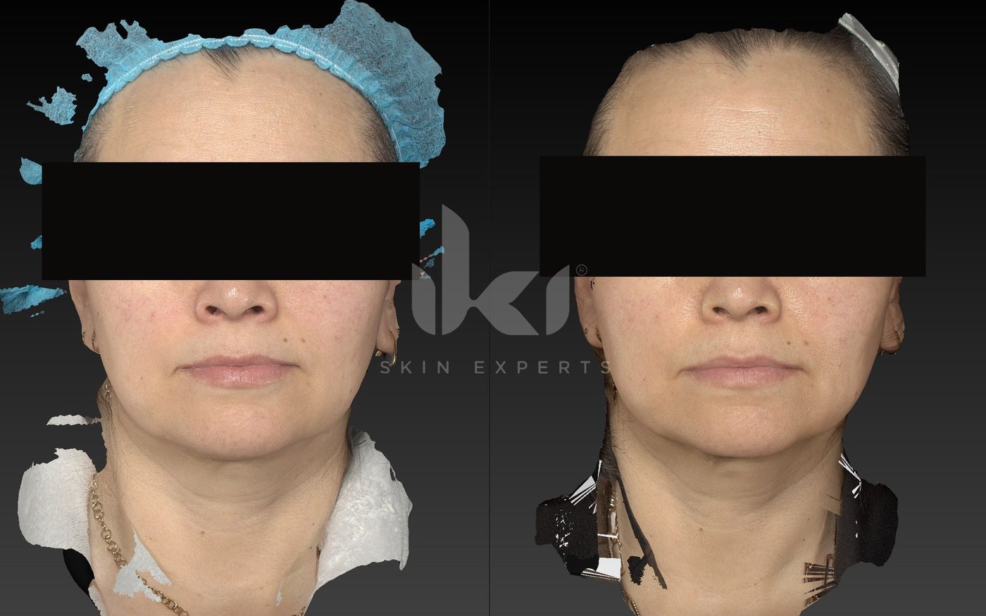 Antes y después de otros casos en IKI Skin Experts, caso 34, identidad protegida