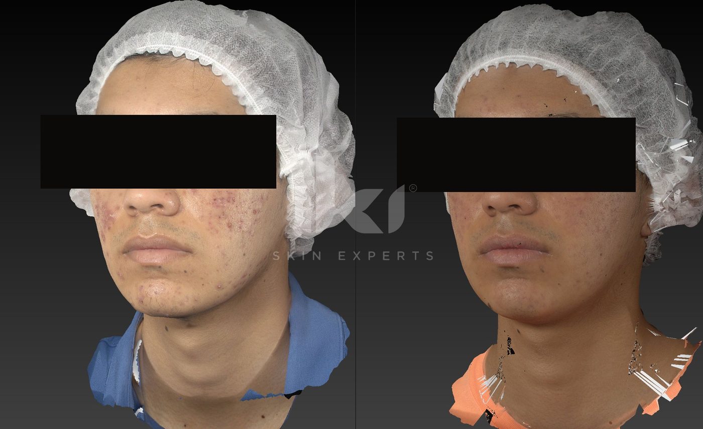Antes y después de acné en IKI Skin Experts, caso 11, identidad protegida