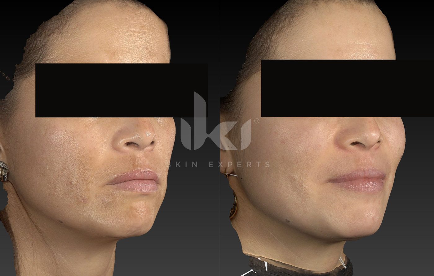 Antes y después de manchas y melasma en IKI Skin Experts, caso 82, identidad protegida