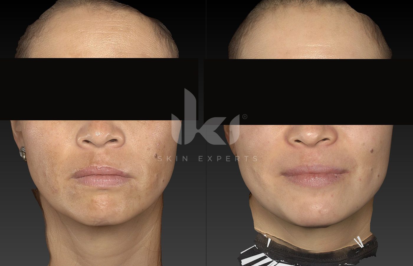 Antes y después de manchas y melasma en IKI Skin Experts, caso 83, identidad protegida