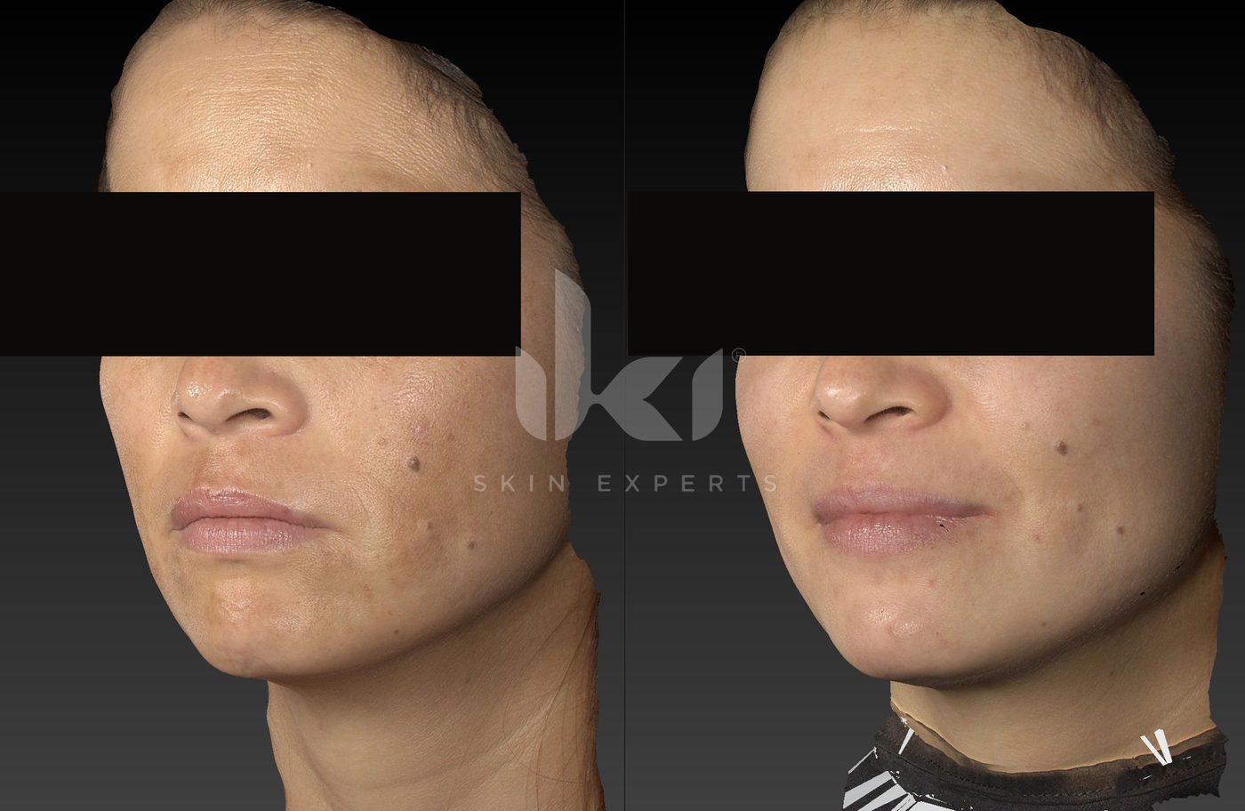 Antes y después de manchas y melasma en IKI Skin Experts, caso 84, identidad protegida