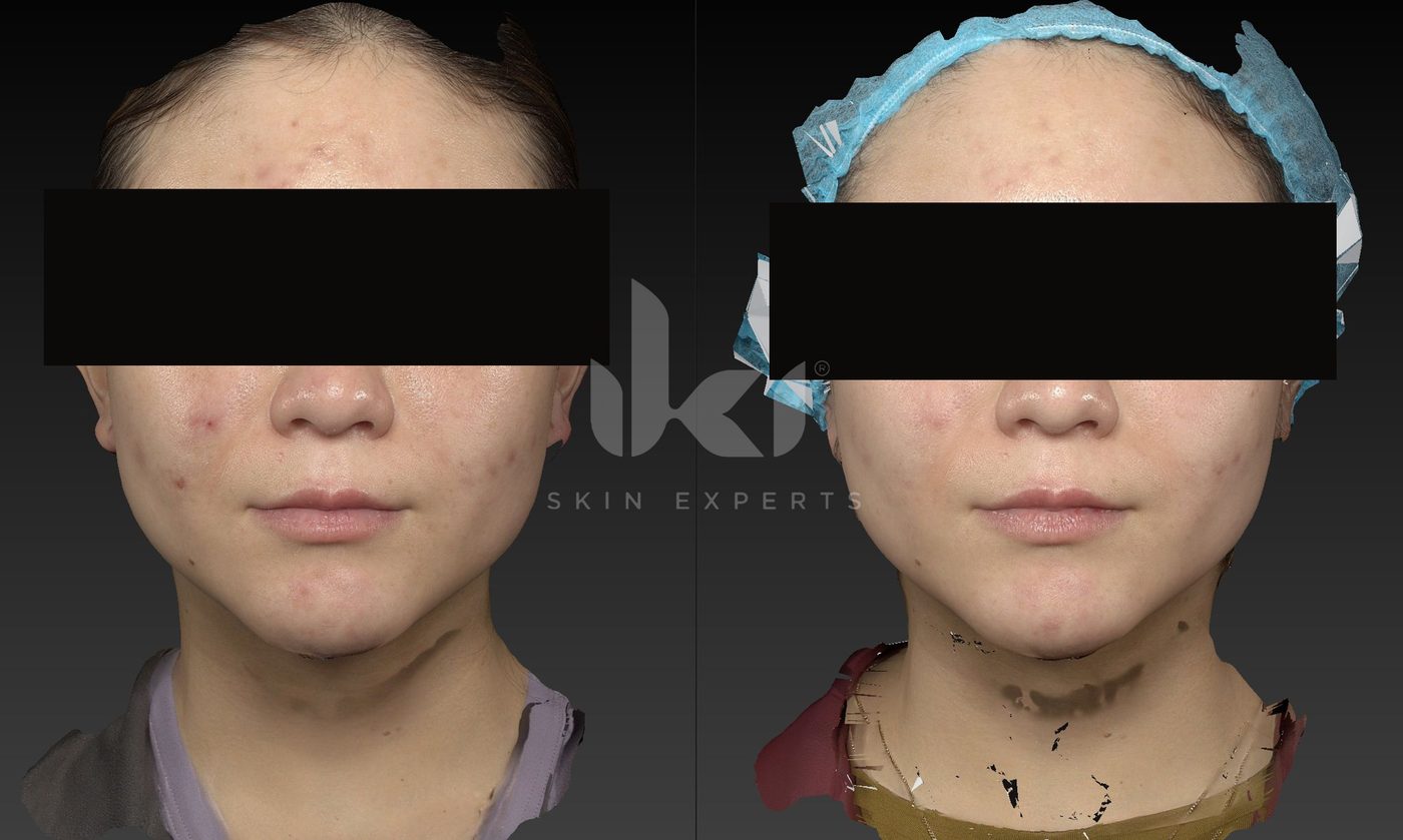Antes y después de acné en IKI Skin Experts, caso 12, identidad protegida