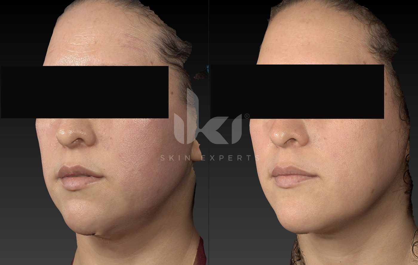 Antes y después de rosácea en IKI Skin Experts, caso 15, identidad protegida