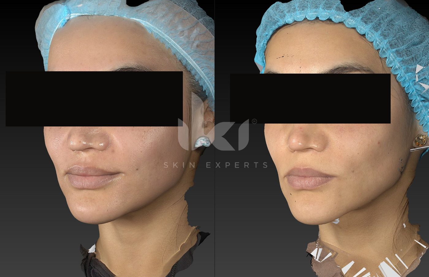 Antes y después de manchas y melasma en IKI Skin Experts, caso 85, identidad protegida