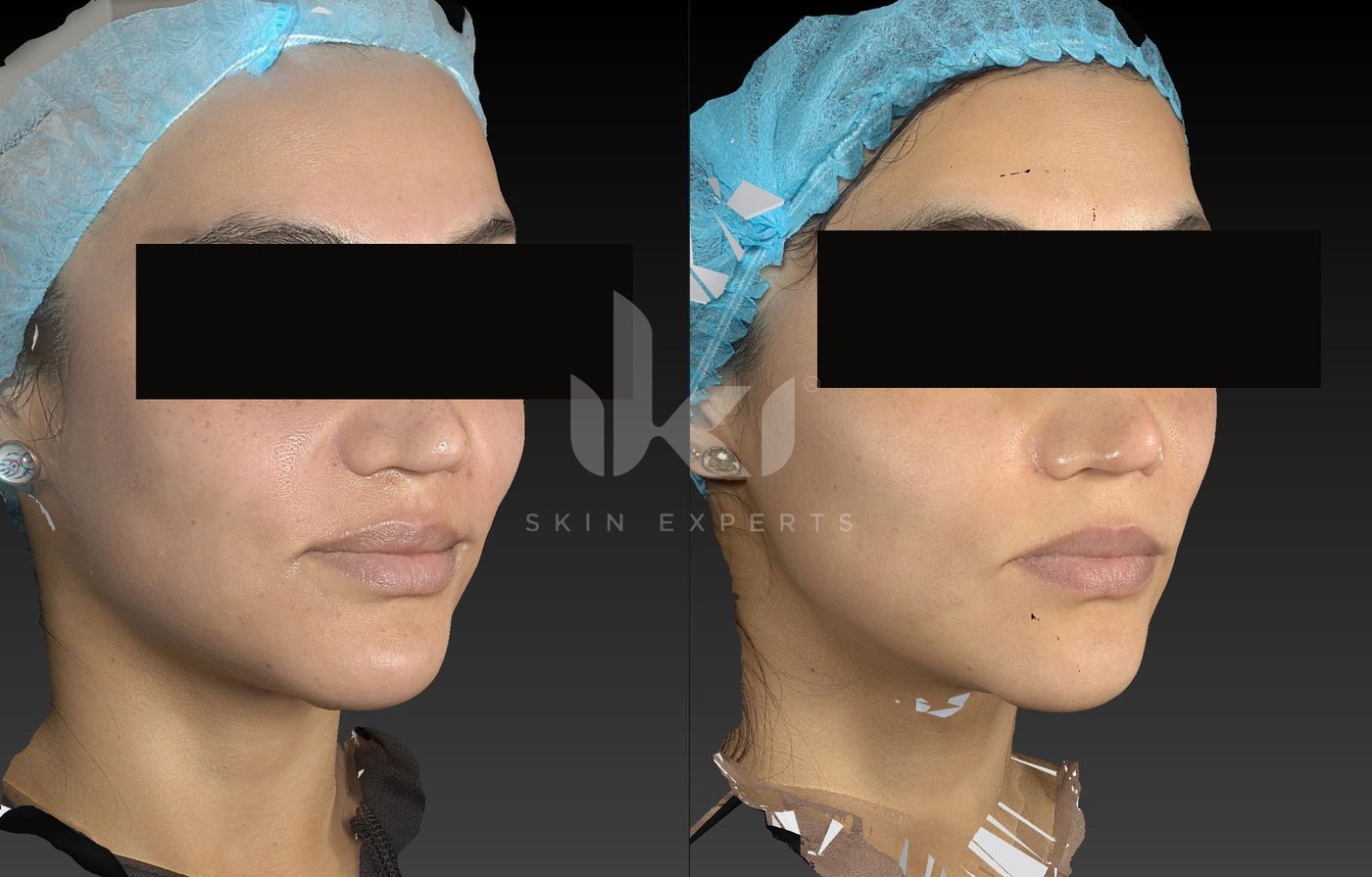 Antes y después de manchas y melasma en IKI Skin Experts, caso 86, identidad protegida
