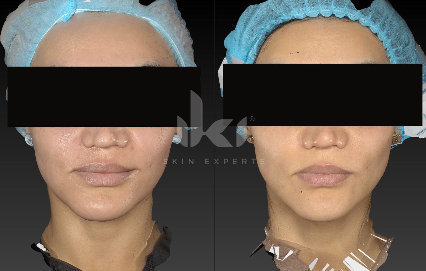 Antes y después de manchas y melasma en IKI Skin Experts, caso 87, identidad protegida