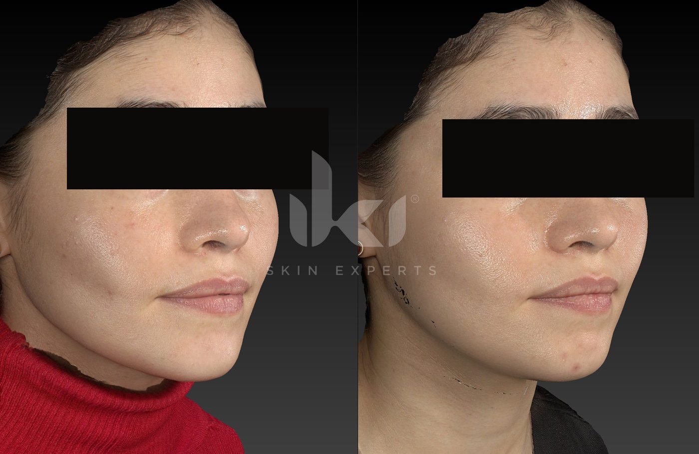 Antes y después de otros casos en IKI Skin Experts, caso 35, identidad protegida