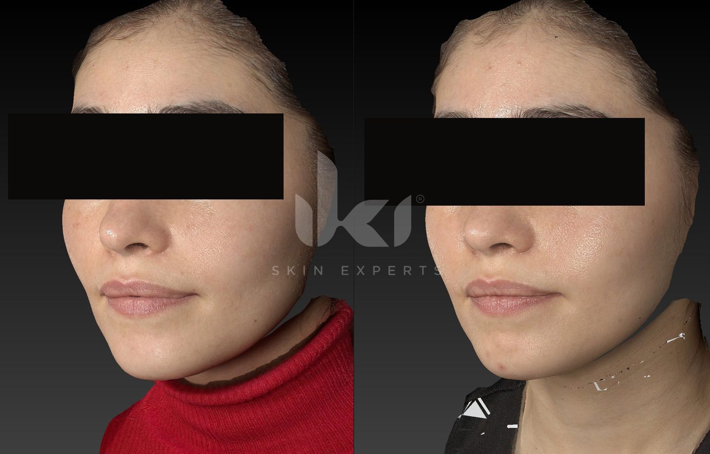 Antes y después de otros casos en IKI Skin Experts, caso 36, identidad protegida