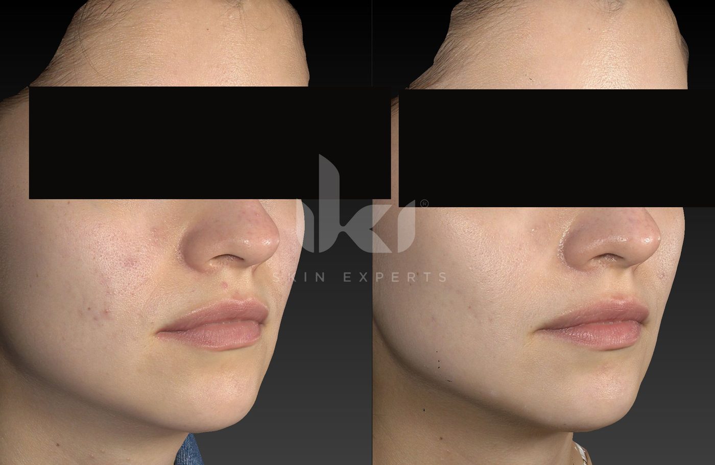 Antes y después de acné en IKI Skin Experts, caso 14, identidad protegida