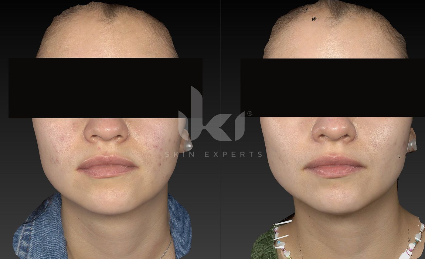 Antes y después de acné en IKI Skin Experts, caso 15, identidad protegida