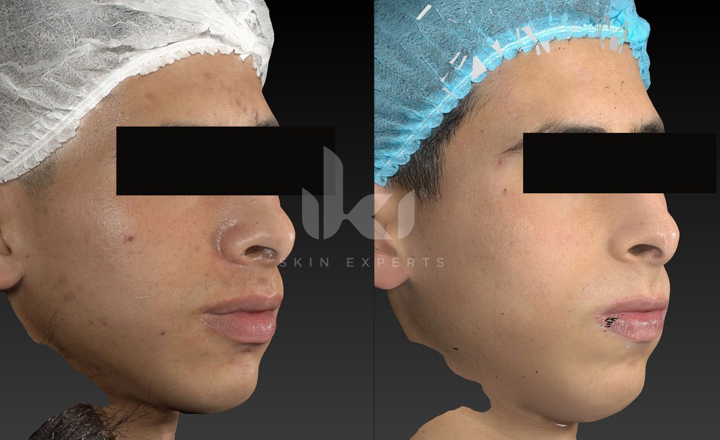 Antes y después de acné en IKI Skin Experts, caso 16, identidad protegida
