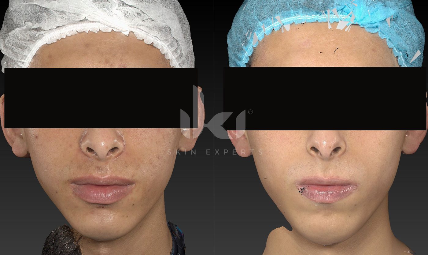 Antes y después de acné en IKI Skin Experts, caso 17, identidad protegida