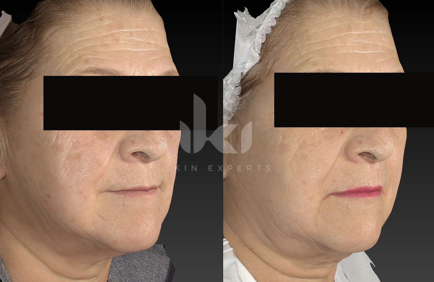 Antes y después de otros casos en IKI Skin Experts, caso 37, identidad protegida