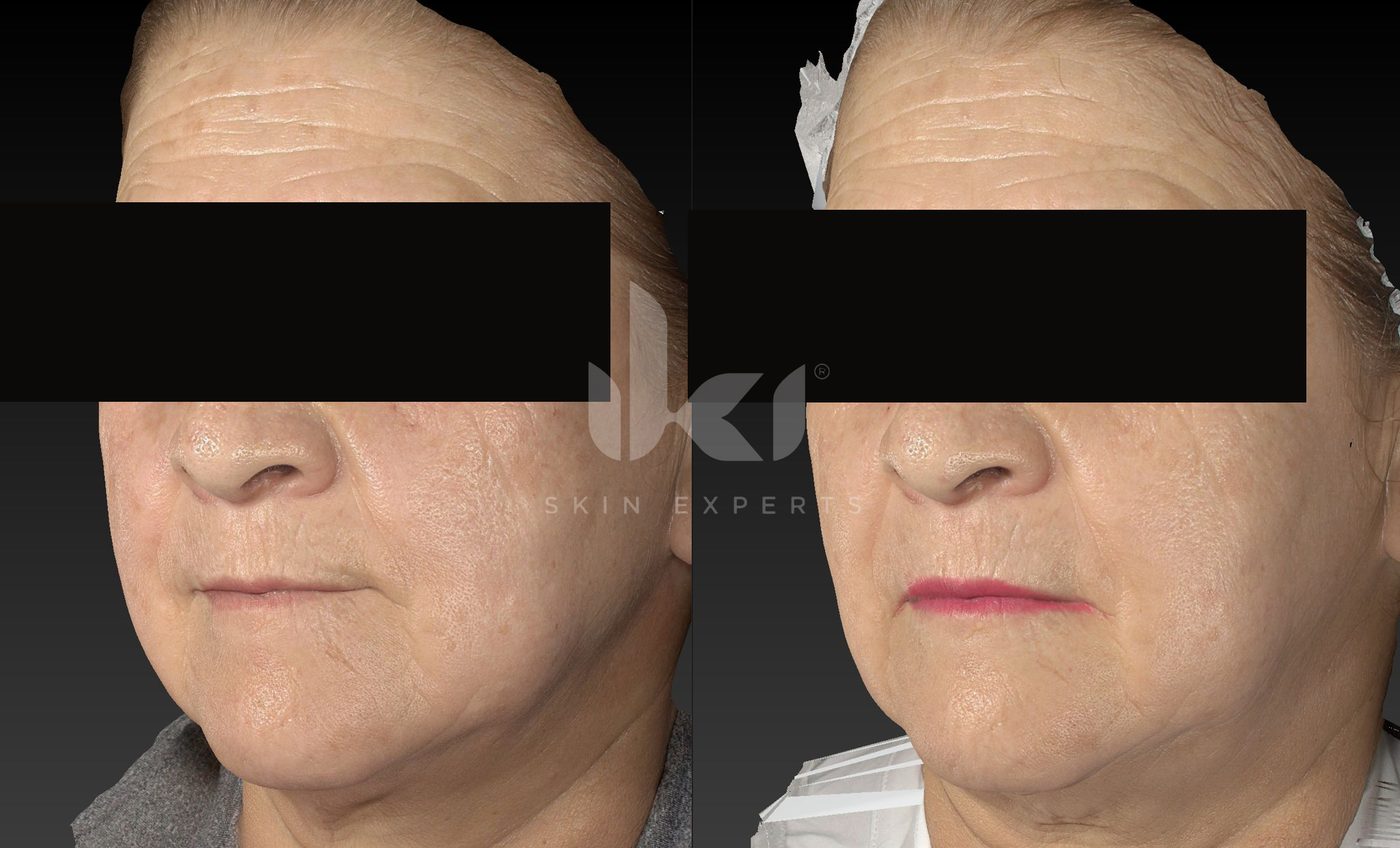 Antes y después de otros casos en IKI Skin Experts, caso 38, identidad protegida
