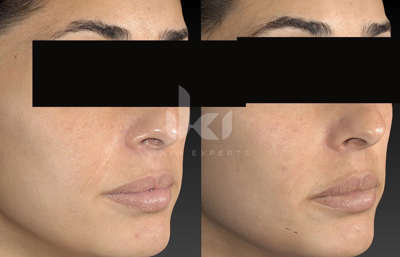Antes y después de rosácea en IKI Skin Experts, caso 16, identidad protegida