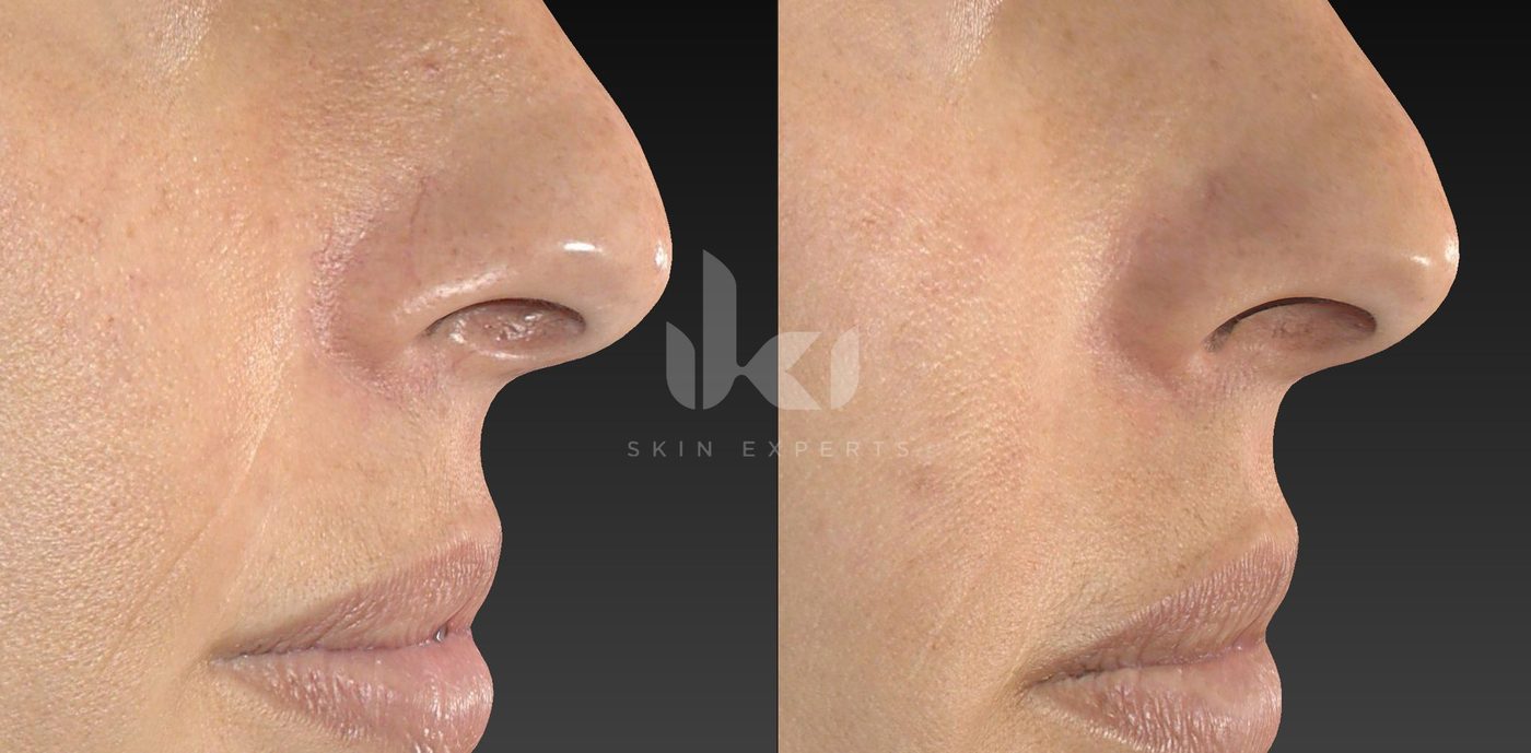 Antes y después de rosácea en IKI Skin Experts, caso 17, identidad protegida