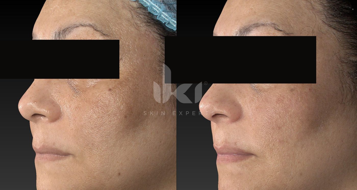 Antes y después de manchas y melasma en IKI Skin Experts, caso 88, identidad protegida