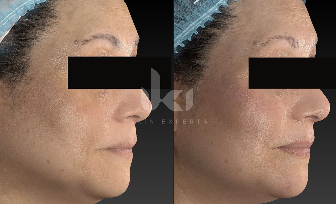 Antes y después de manchas y melasma en IKI Skin Experts, caso 89, identidad protegida